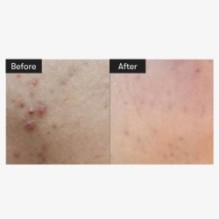 VT - Reedle Shot 300 Mini